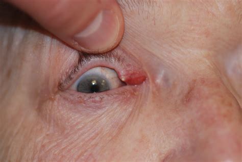 What Is the Cause of This Patient’s Ocular Symptoms? | Consultant360