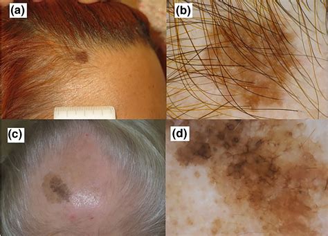 Stage 4 Melanoma Cancer