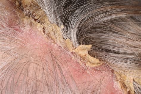 Erosive pustular dermatosis - Stock Image - C054/9569 - Science Photo ...