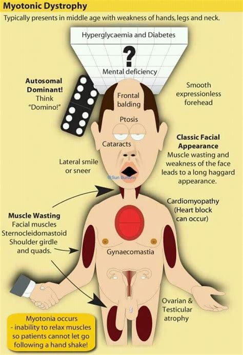 Mytonic Dystrophy - MEDizzy