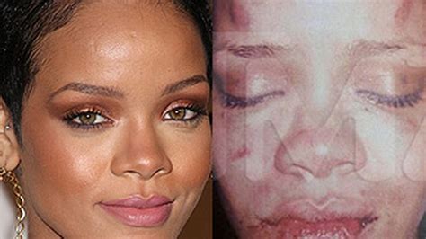 Rihanna's battered face: Leaked picture shows injuries after alleged ...