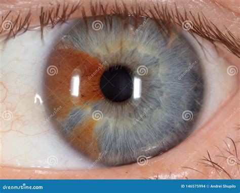 Birthmark on the eye stock photo. Image of brown, shell - 146575994