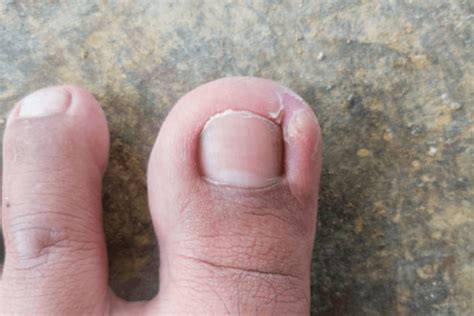 Ingrown Toenail Treatment | Buffalo Grove Podiatry