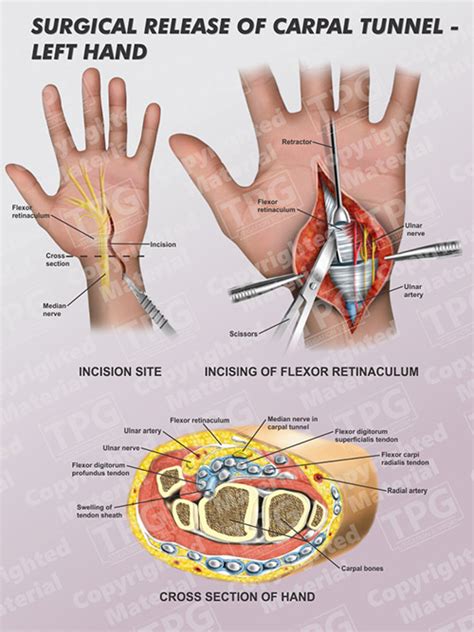 Surgical Release of Carpal Tunnel Left - Order