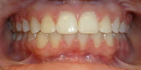 Before & After Orthodontics Photos - Murray Orthodontics