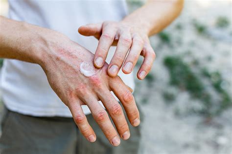 Irritant Contact Dermatitis Hand