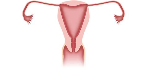 Schematic drawing of an arcuate uterus. As a mild form of resorption... | Download Scientific ...