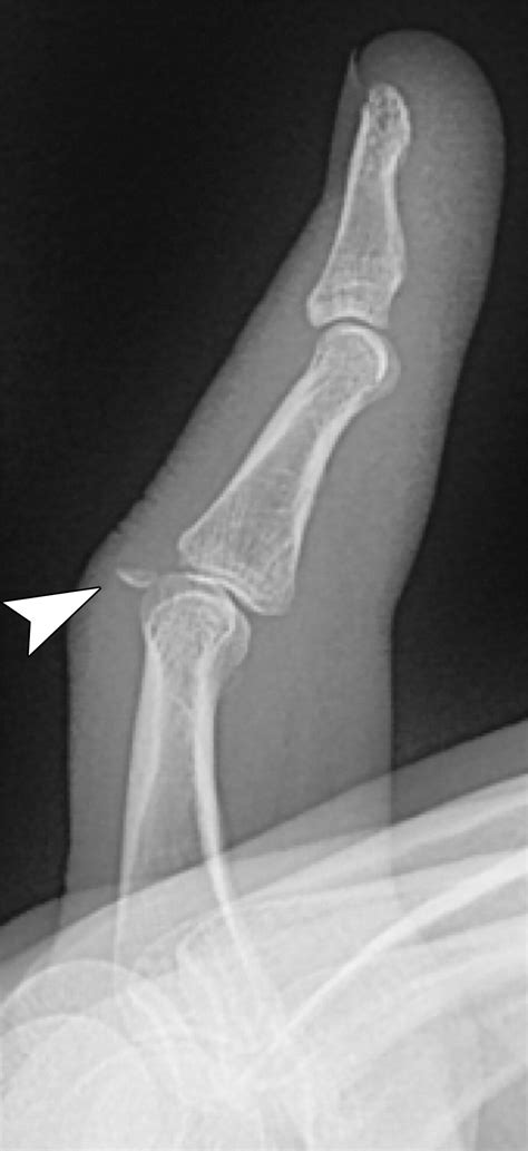 Avulsion Injuries of the Hand and Wrist | RadioGraphics