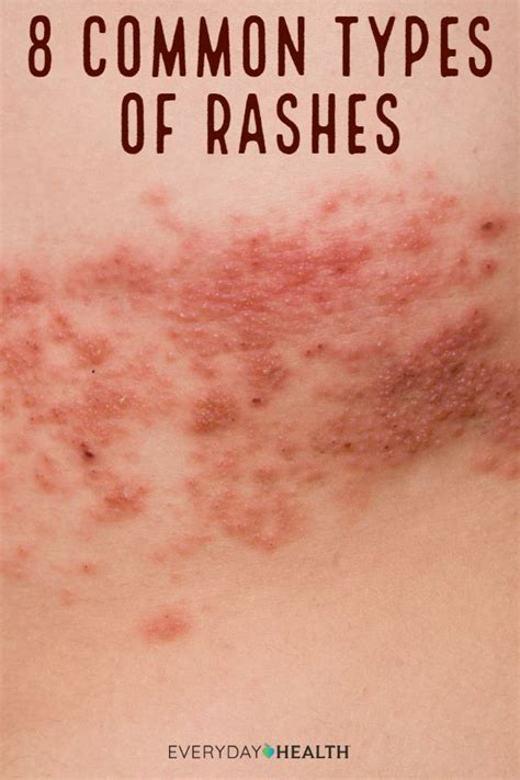 Skin Rashes Identification