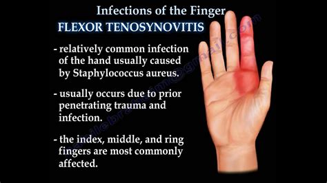 CELLULITIS / Fascitis / Infection / Tendon sheath infection finger - Max Superspecialty Ortho Clinic