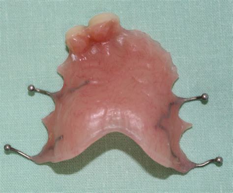 2-plastic-partial-denture-replacing-front-teeth