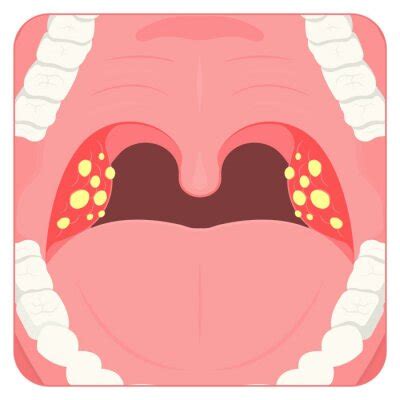 Tonsil stones crypts viral virus gland strep throat sore enlarged • wall stickers uvula, swab ...
