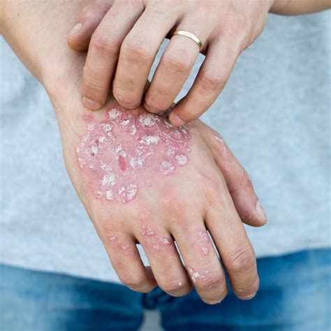 Arriba 93+ Foto Fotos De Psoriasis En El Cuero Cabelludo Mirada Tensa