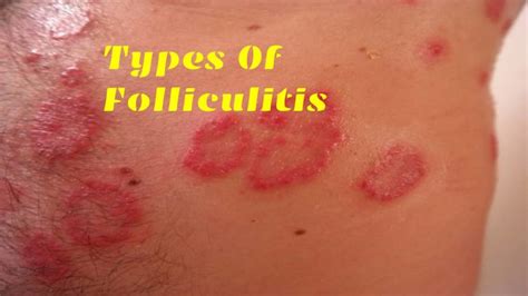 Folliculitis Symptoms Causes And Different Types Including Risk Factors - kulturaupice