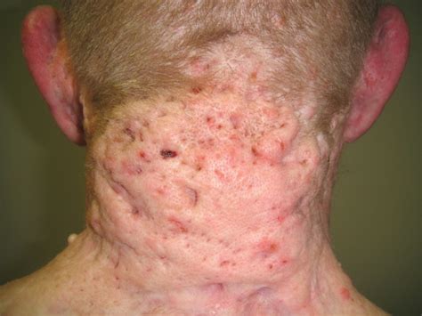 Hidradenitis Suppurativa Scalp