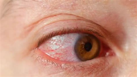 Bacterial Keratitis: Causes, Symptoms, and Treatment Options