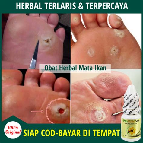 Obat Mata Ikan, Salep Penghilang Mata Ikan di Telapak Kaki & Tangan ...