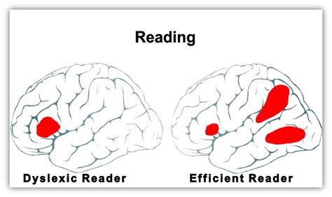 The Causes of Dyslexia - What the Latest Science Reveals