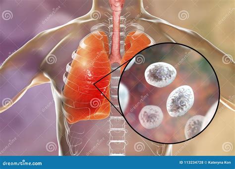 Pneumocystis Jirovecii, Opportunistic Fungus That Causes Pneumonia In ...