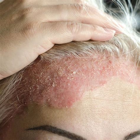 Scalp Psoriasis: Home Remedies and Tips for Relief – Forces of Nature Medicine
