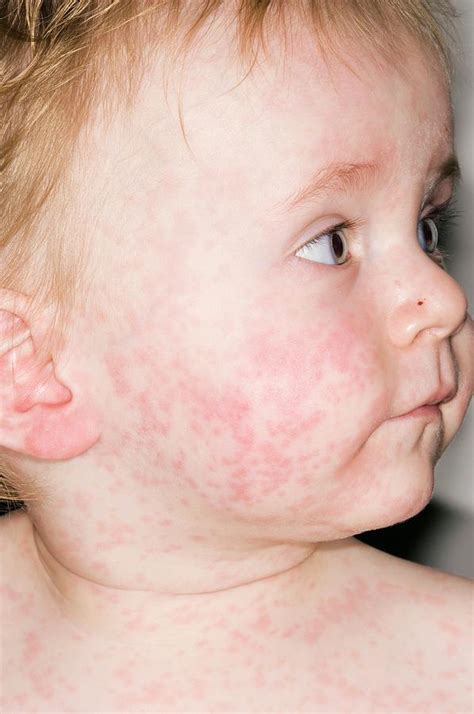 Red Cheeks Viral Infection at James McElyea blog