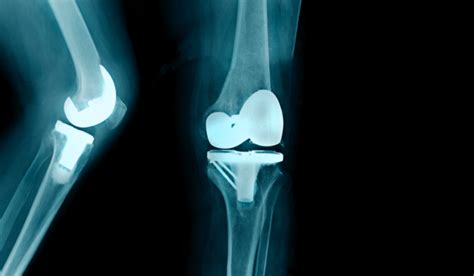 What Is a Total Knee Replacement Surgery? | Curovate