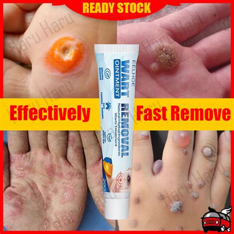 【EELHOE】 Warts Remover Original Cream Wart Remover Ointment Wart ...