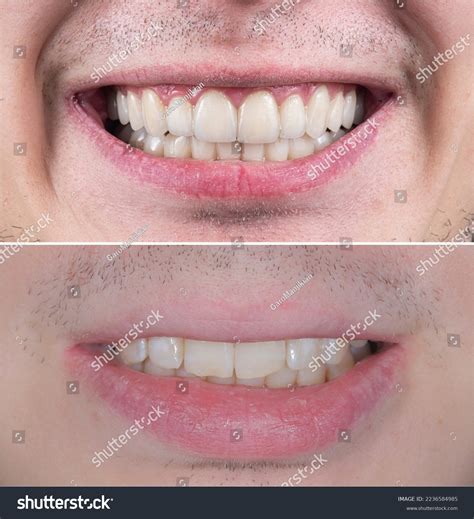 Dental Before After Picture Placing Ceramic Stock Photo 2236584985 ...