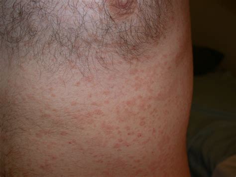 Pityriasis Rosea Pityriasis Rosea Pictures Stages Cau - vrogue.co