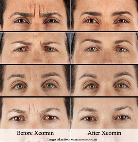 XEOMIN Dermscapes Medical Spa, Bakersfield CA, California, Kern County, Central Valley, Fresno ...