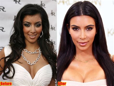 Kim Kardashian Face Surgery Before And After Photos