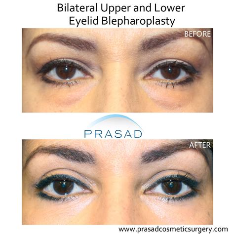 Eye Lift Before and After Photos | Prasad Cosmetic Surgery NY