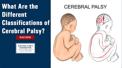 What Are the Different Classifications of Cerebral Palsy?