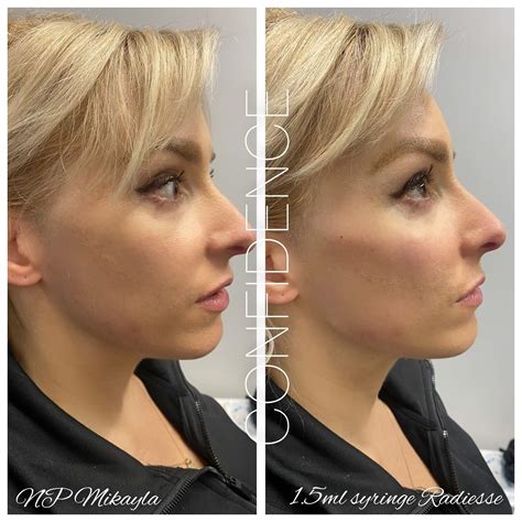 Injectables | Confidence Med-Spa