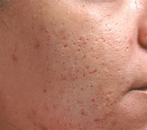Pox marks: Can they be removed? | Miravue Skin Clinic