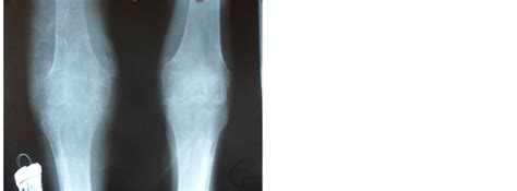 Concomitant Septic Arthritis on Gouty Arthropathy: A Case Report