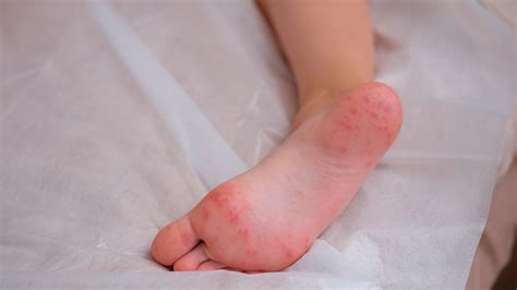 Foot Dyshidrotic Eczema: Symptoms And More, 50% OFF