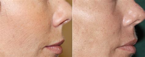 Skin Rejuvenation photos | Beverly Hills, CA. | Patient 16249