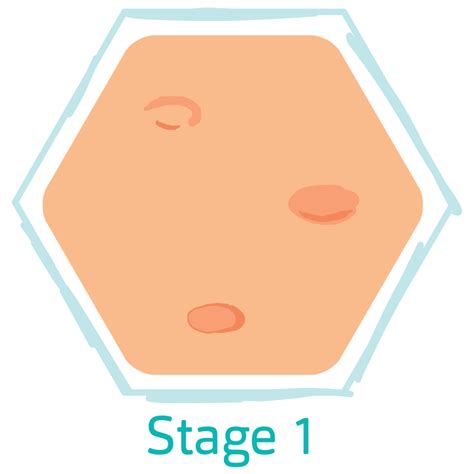 Hidradenitis Suppurativa Stages - HidraWear