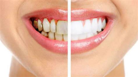 Black Spots On Teeth Home Remedies - Teeth Poster