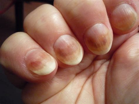 What Causes Fingernails To Change Colour at Melvin Erickson blog