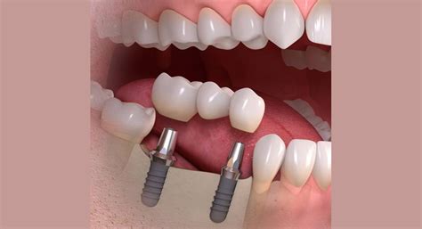 Dental Implants & Crown Placement in Thrissur| Implantology treatment| Emerald Dental Clinic