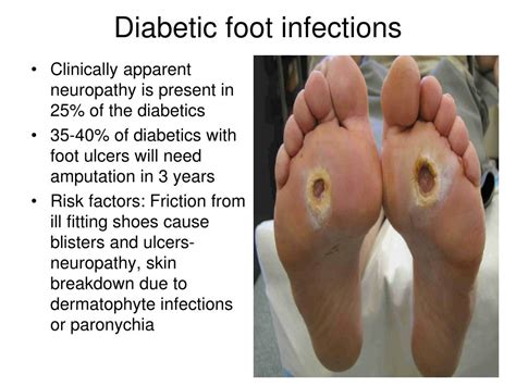 PPT - Infections in diabetes PowerPoint Presentation, free download ...