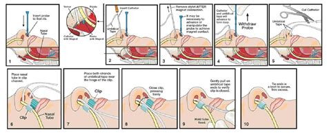 Figure 2 from Nasal Bridle : Married to Your Tube CASE SCENARIOS ...