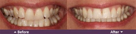Retainer Before and After | New Health Advisor