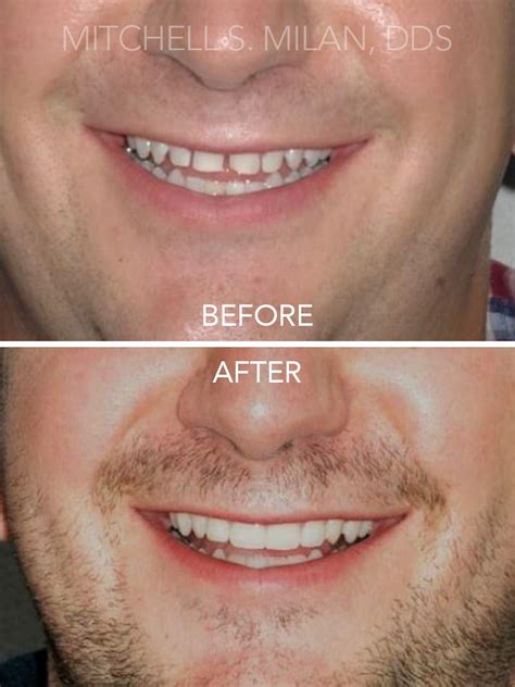 scott-before-after - Birmingham Center for Cosmetic Dentistry