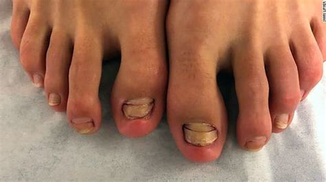 Woman loses toenails months after fish pedicure | CTV News