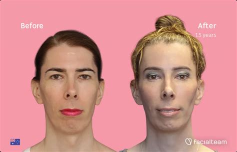 Adam’s Apple Reduction vs. Voice Feminization — Facialteam