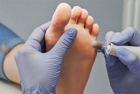 Plantar Wart Removal Cryotherapy | Bruin Blog