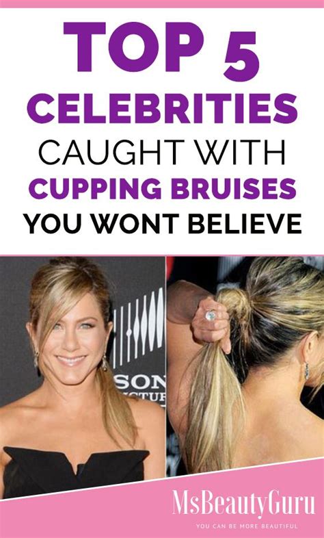 Top 5 Celebrities Caught with Cupping Bruises You Won't Believe | Celebrities, Celebrity gossip ...